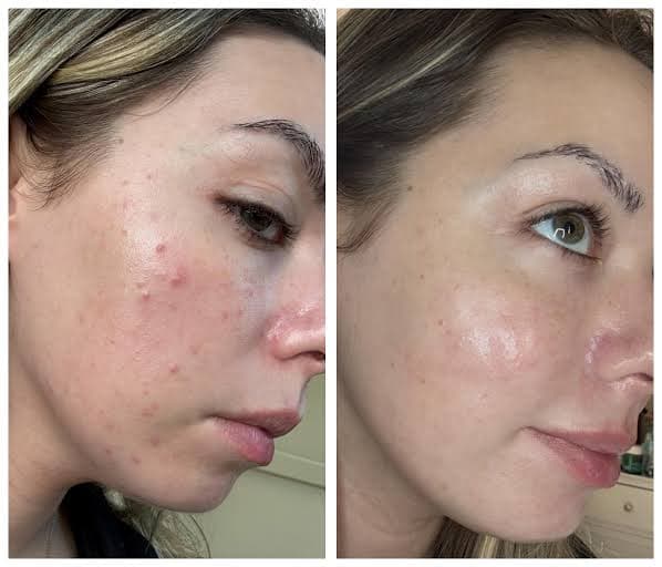ANUA Azelaic Acid 10% + Hyaluron